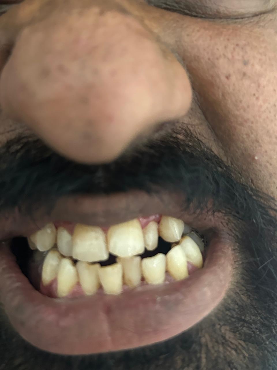 After Scaling — Clean teeth post treatment