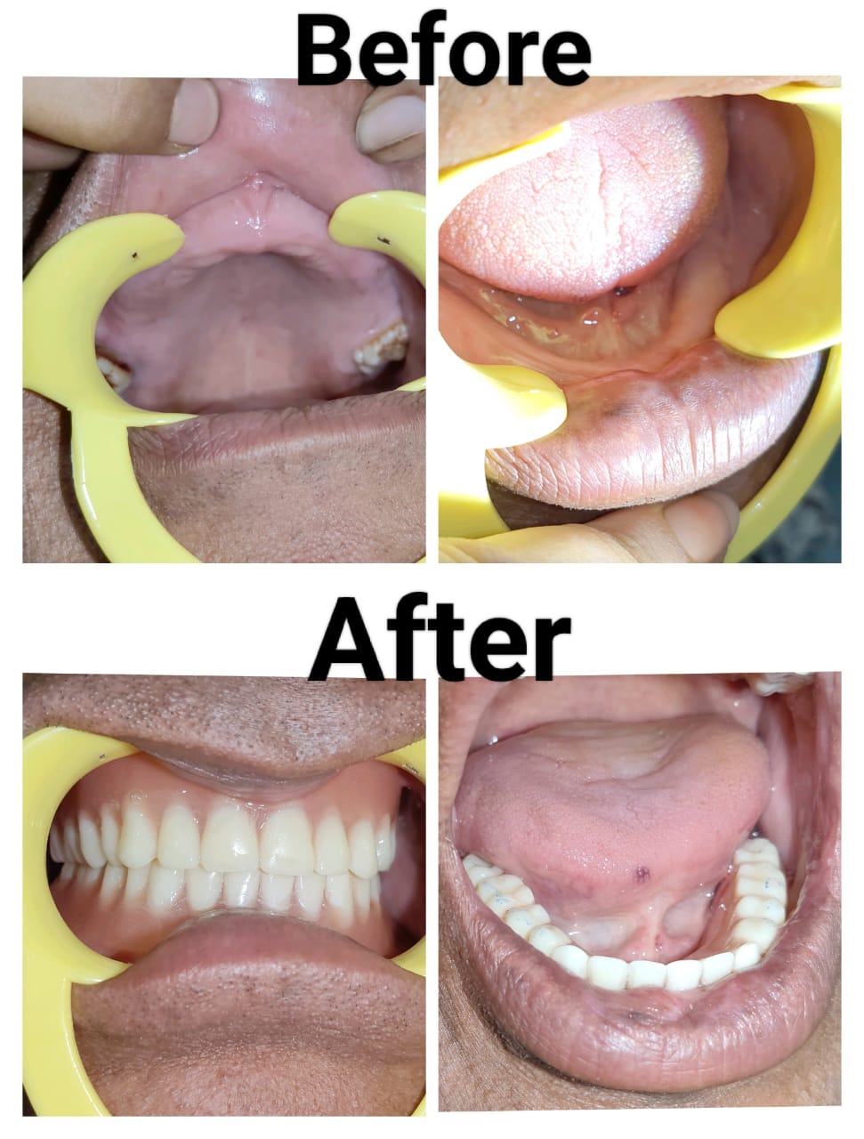 Complete Denture Before and After — Deeksha Dental Care Bikaner