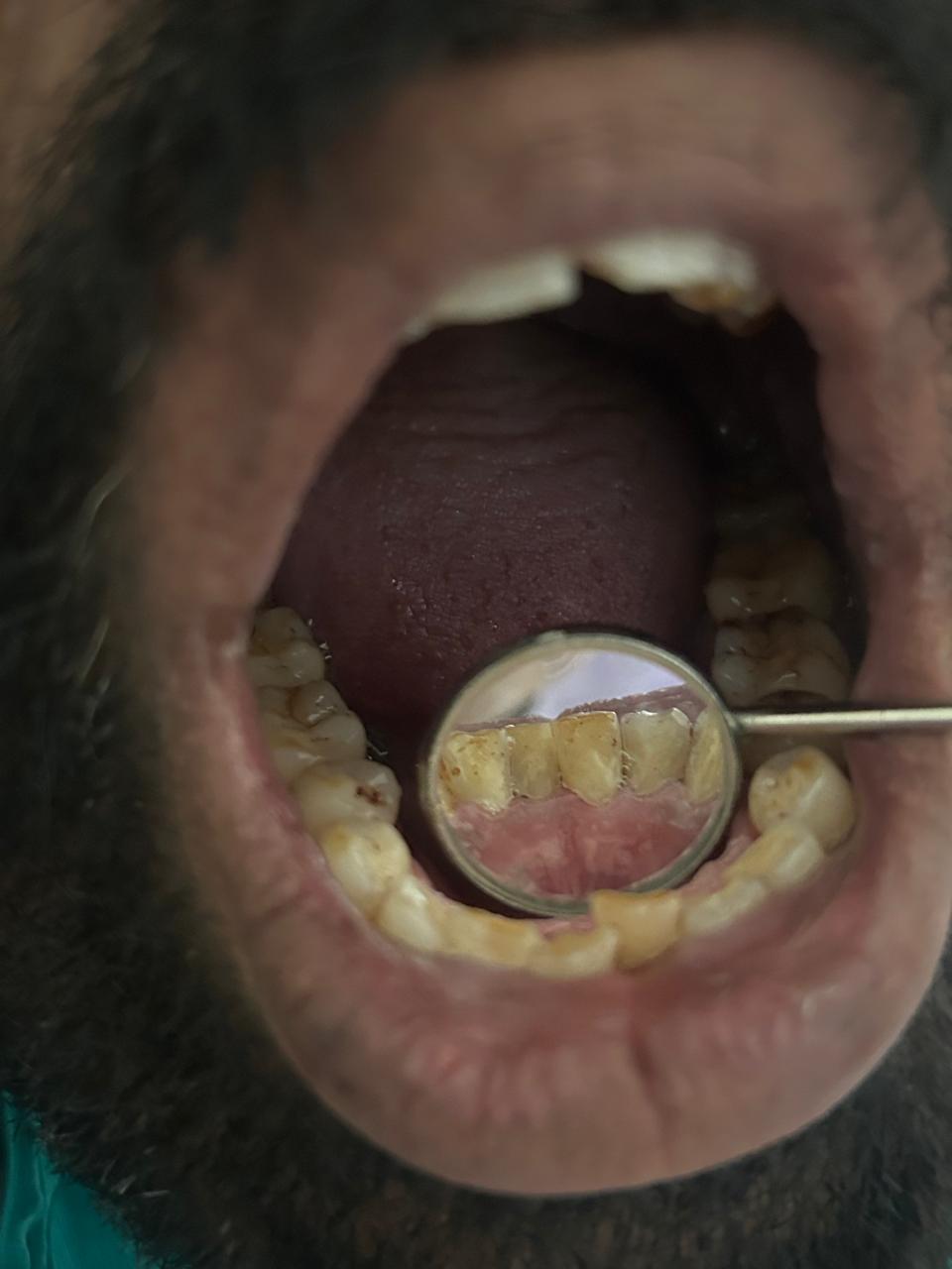 Lingual surface calculus deposits — tongue side view