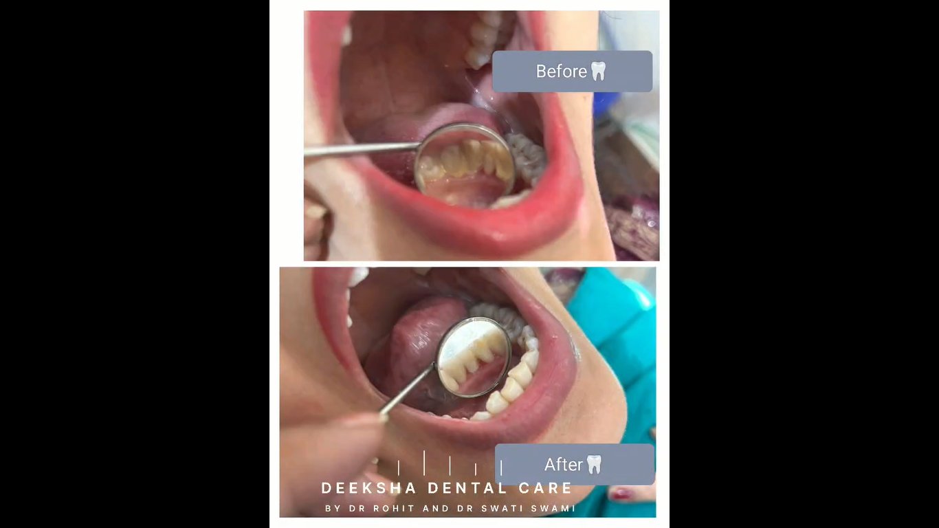 Professional ultrasonic scaling — Deeksha Dental Care Bikaner