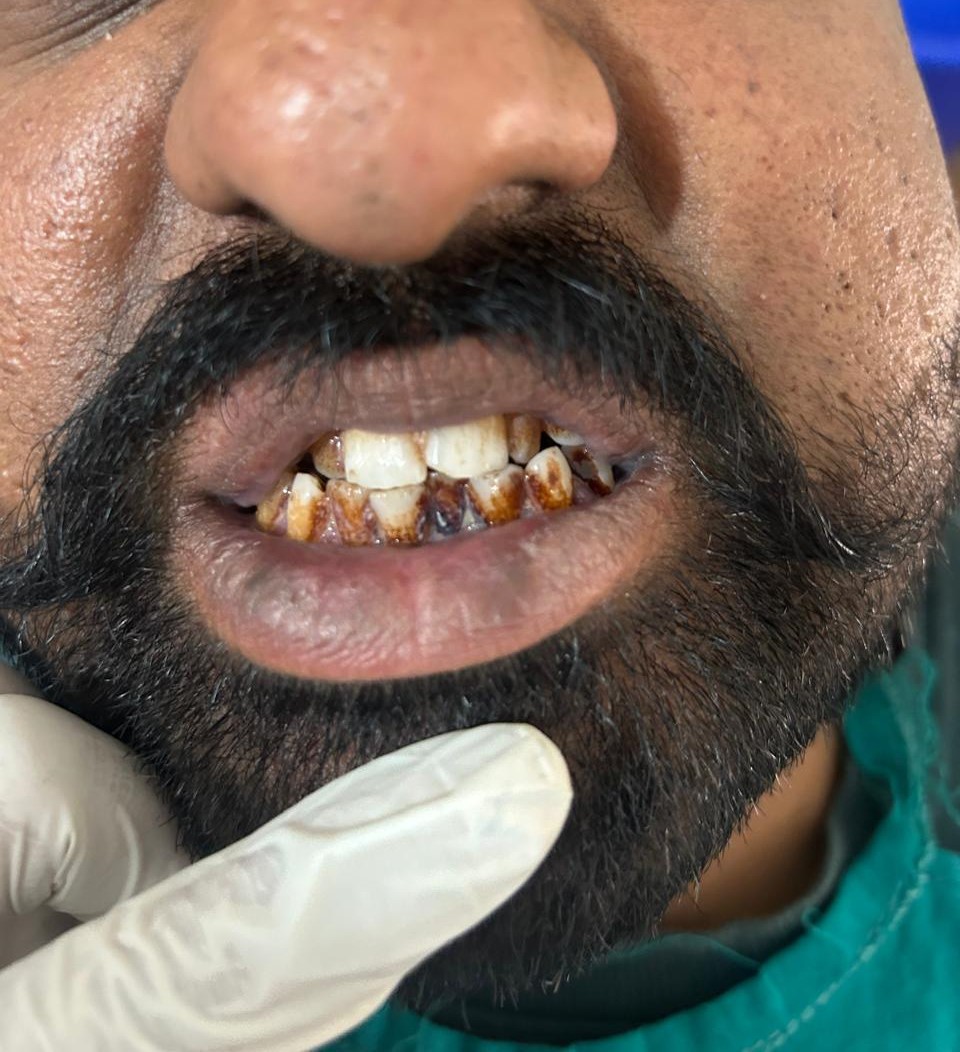 Before Scaling — Severe stain and tartar buildup