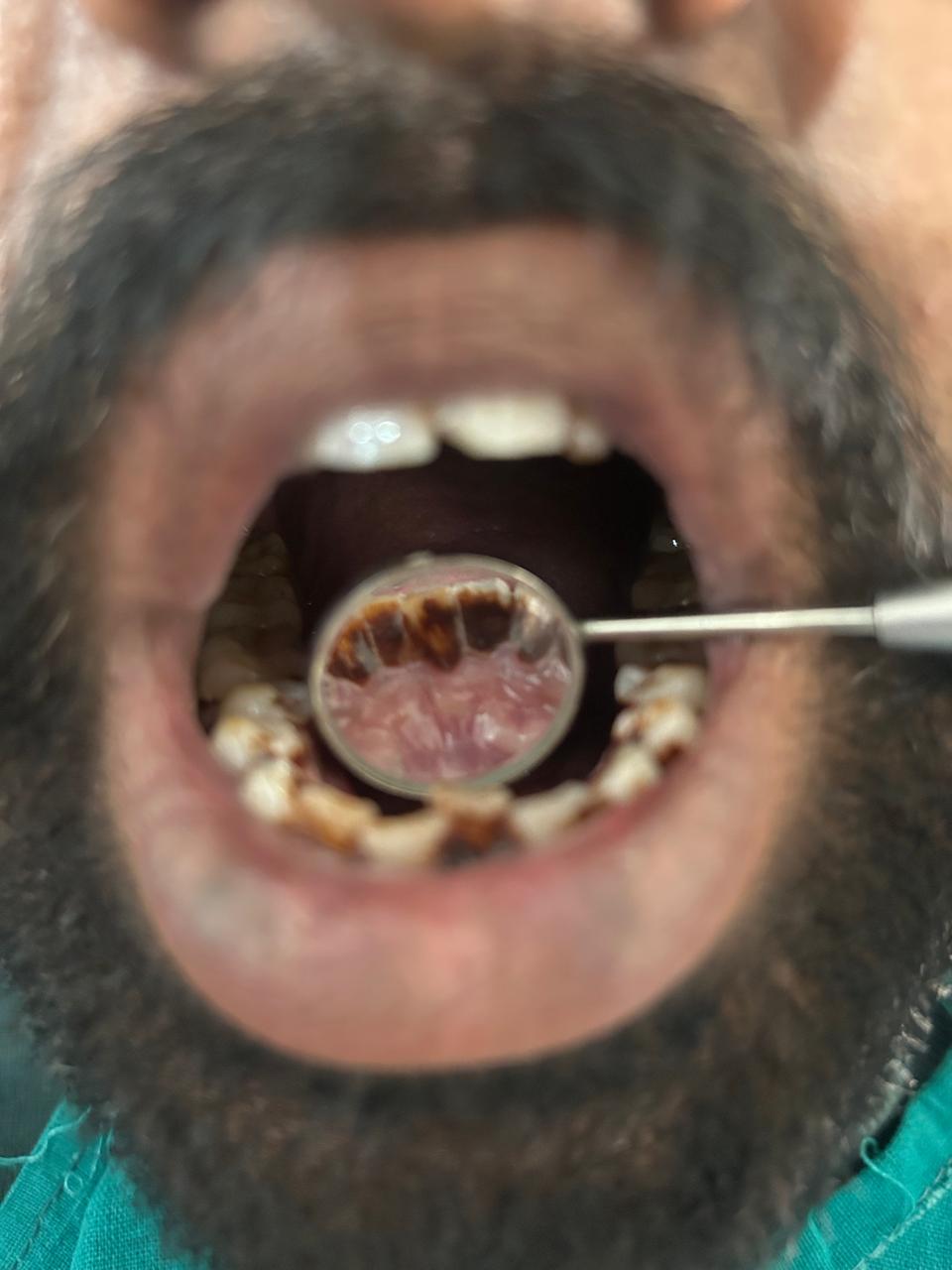 Severe staining and calculus — Deeksha Dental Care